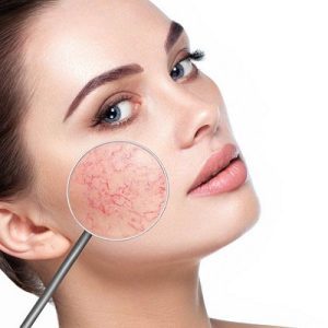 Rosacea Treatment in Dubai
